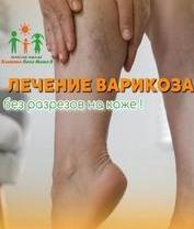 Лечение варикоза